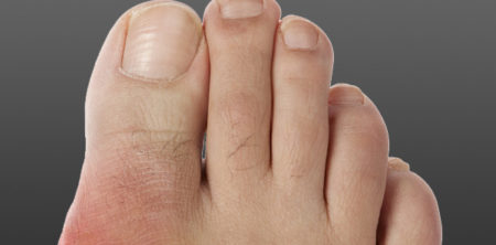 Natural Remedies for Gout