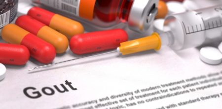 The Relationship Between Uric Acid and Gout