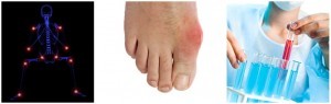Gout Treatment - Find Relief with Urcinol | PurMEDICA