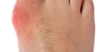 Everything You Need To Know About Gout!