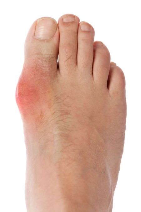 gout attack on big toe