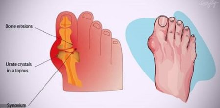 The 7 Foods That Will Make Gout Worse