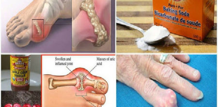 House Hold Products That Can Help With Gout
