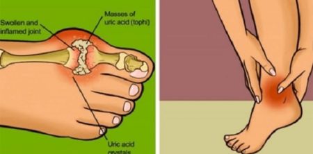 8 Ways to Reduce Uric Acid Crystals Naturally