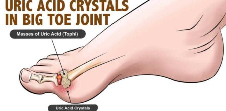 Do You Know These Ways To Deal With Gout?