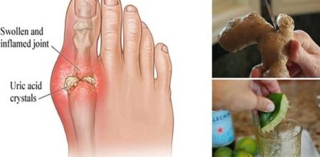 Actions To Take To Reduce Uric Acid And Prevent Gout